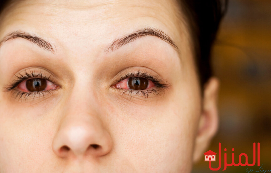 اسباب التهاب العين وطرق العلاج