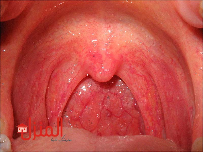 احتقان الحلق أسبابه وأعراضه